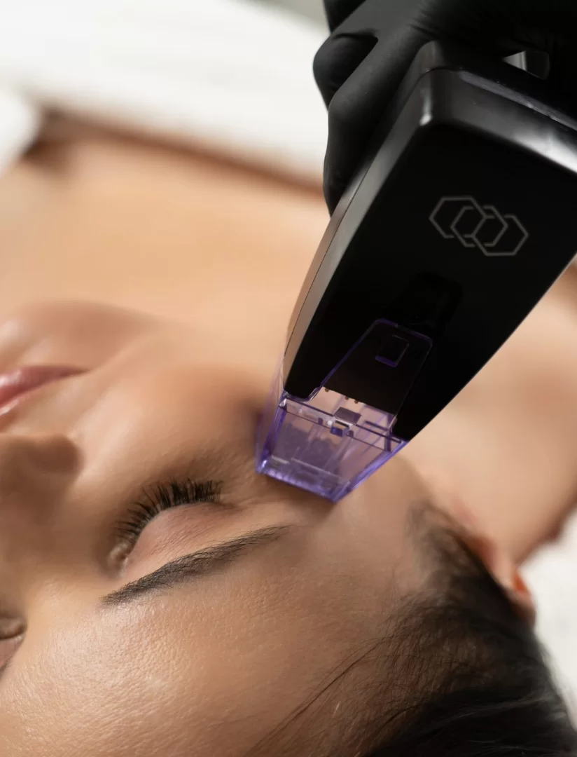 Morpheus8 treatment at Ccoco Beauty Balwyn