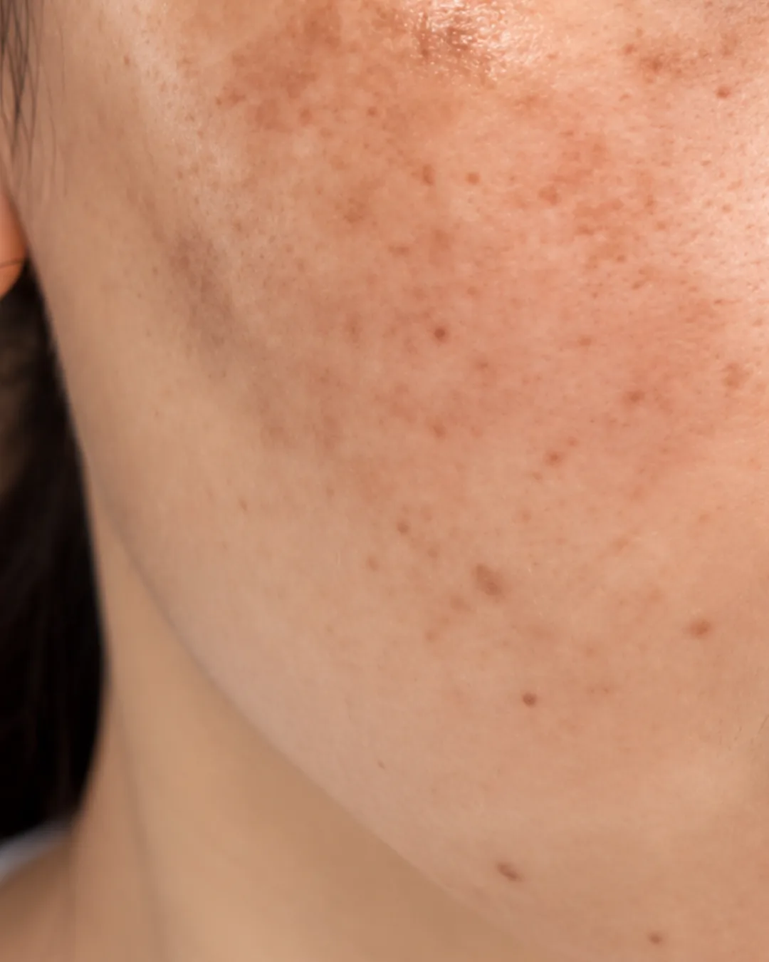 Pigmentation & Uneven Tone