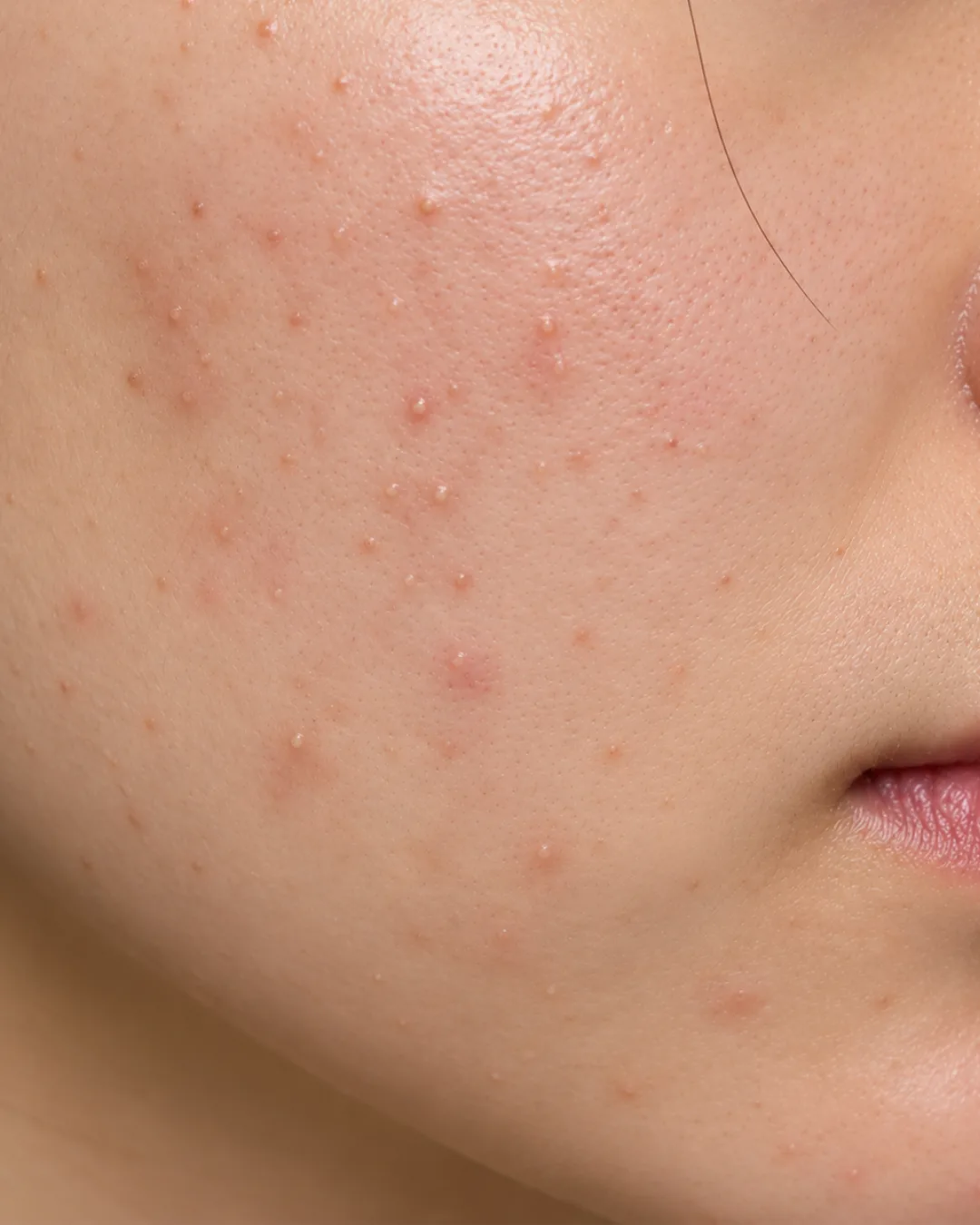 Acne & Congestion
