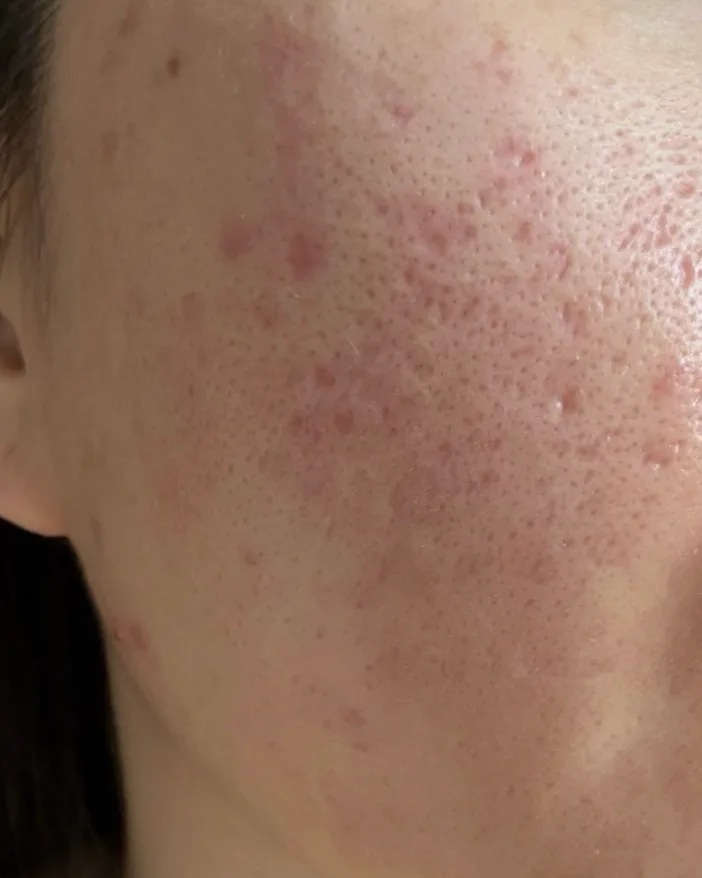 Pores & Skin Texture illustrative skin concern